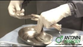 Gabriele Antonini – Impianto protesi del pene – www.antoniniurology.com (HQ)